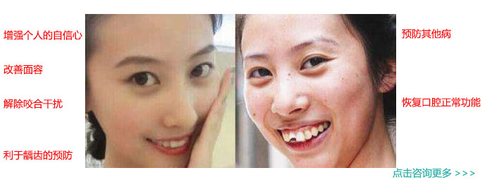 暴牙矫正大概要多少钱,哪里暴牙矫正好?