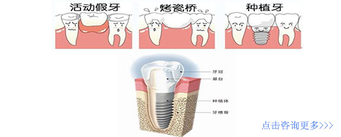 微创种植牙：伤害小 舒适方便
