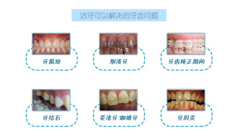 那些人适合洗牙