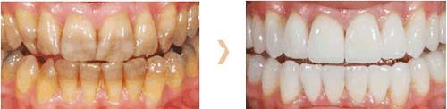 氟斑牙的三种牙齿症状表现，你属于哪一种？ 