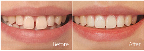 对于牙齿矫正，你了解多少那？