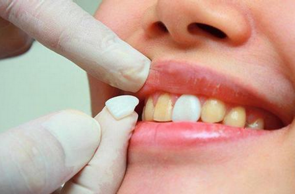 全瓷牙、牙贴面和全瓷牙贴面如何区别?
