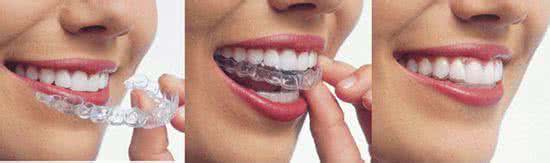 前牙深覆盖牙产生的原因都有那些？