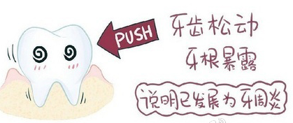 牙结石口臭可能是牙周炎发作