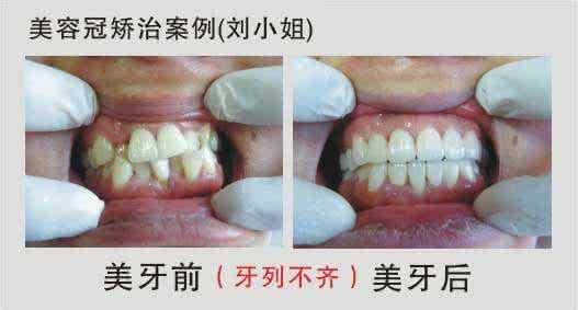 专家解析如何选择好的烤瓷牙?