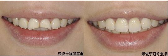 全瓷牙最具吸引的三大优势