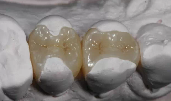 补牙怎么补的?补牙过程