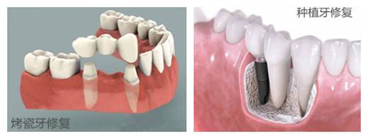 种植牙与传统假牙对比好在哪里？
