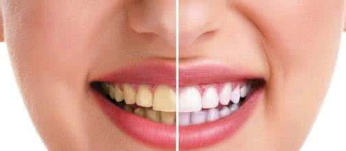  牙膏含氟会导致氟斑牙这是真的吗？