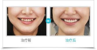 虎牙矫正前后效果对比图