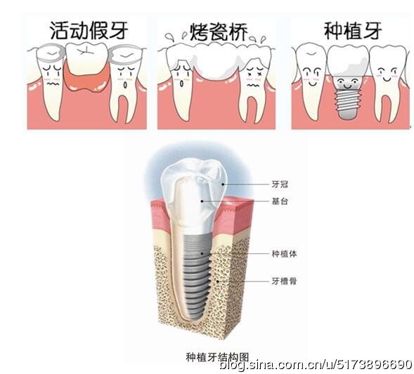全球四大顶级口腔种植系统