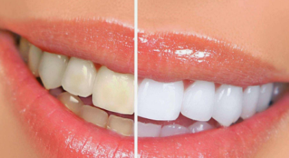牙齿变白的方法都有那些？
