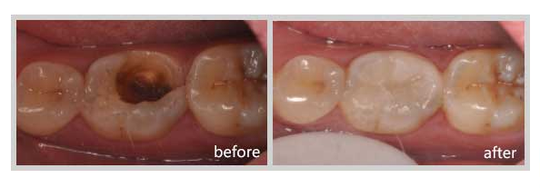  修复蛀牙的首选美国3M树脂补牙