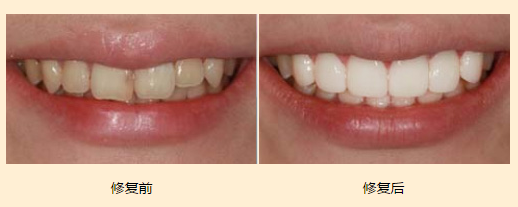 牙齿贴面修复美白牙齿常见的三种材料