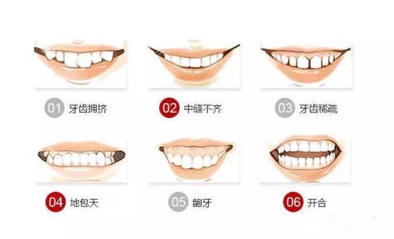 那些症状牙齿需要矫正