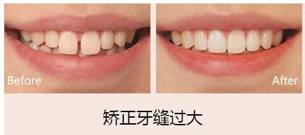 牙齿门牙缝隙大的原因大全