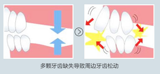 为什么会出现牙齿缺损?